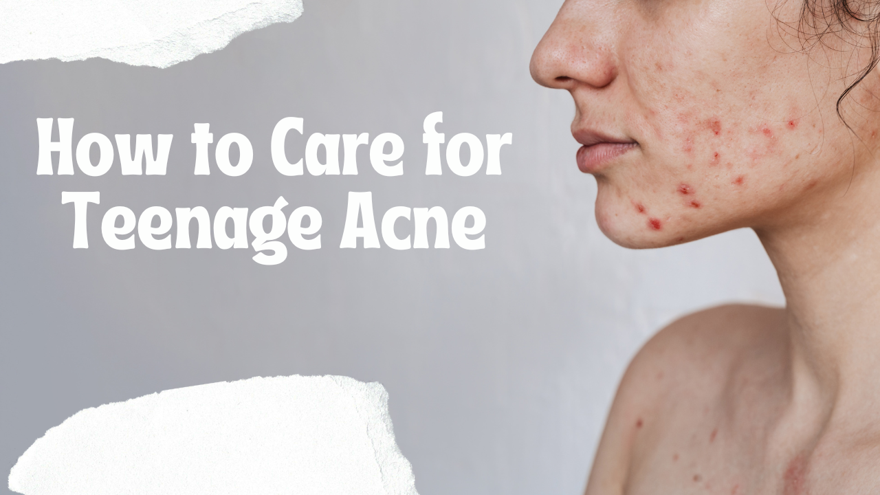 How to Care for Teenage Acne